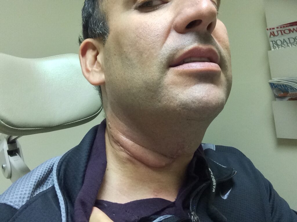 SupermanHPV neck tumor